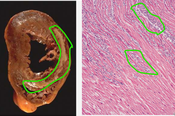 <ul><li><p>susiformuoja jungiamasis audinys</p></li><li><p>matomos mikroskopiškai imuninės ląst - neutrofilai, branduolio nėra</p></li></ul><p></p>