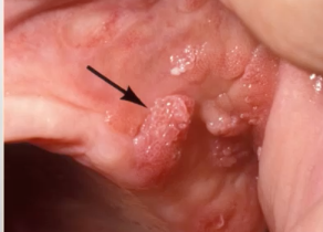 <p>HPV 6 and 11 lesion with sessile base and multiple papules, most commonly on LABIAL MUCOSA</p>