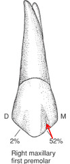 <p>Is the PKT notch located more mesial or distal on maxillary first premolars?</p>