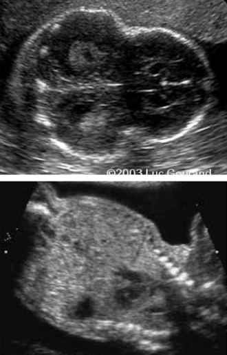 <ul><li><p><span style="color: red;">severe micromelia</span></p></li><li><p><span style="color: red;">cloverleaf deformity</span></p></li><li><p><span style="color: red;">narrow thorax with shortened ribs (bell-shaped)</span></p></li><li><p>rhizomelia</p></li><li><p>protuberant abdomen</p></li><li><p>frontal bossing</p></li><li><p>hypertelorism</p></li><li><p>flat vertebral bodies</p></li></ul><p></p>