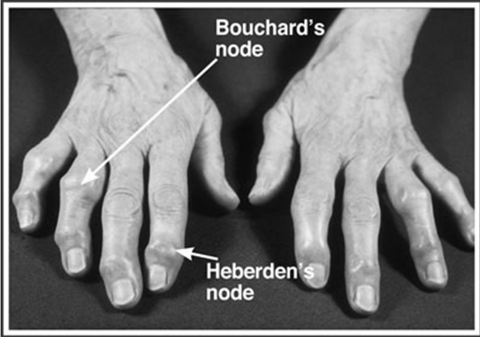 <p>They are bony swelling as a result of OA in the DIP/PIP</p><p>DIP: Hebeden’s</p><p>PIP: Bouchard’s </p>