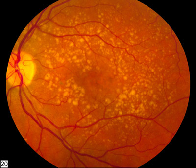 <p>dry macular degeneration finding*</p>
