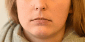 <p>Chin Raiser</p>