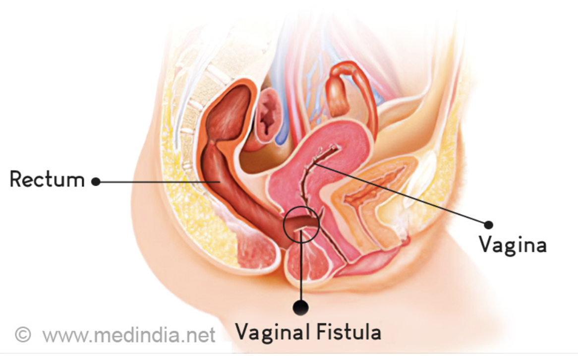 <p><span>an injury in the birth canal that allows leakage from the bladder or rectum into the vagina, leaving a woman permanently incontinent</span></p>
