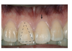 <p>thick scalloped biotype</p>