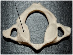 <p>Name this specific part of the atlas (C1). Include directional term.</p>