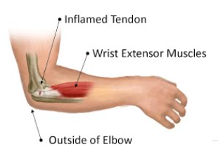 <p><span style="background-color: transparent;"><strong>&nbsp;What is the name of the injury shown in the picture below?</strong></span></p>