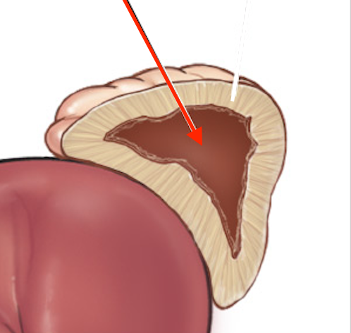 <p><span style="font-size: calc(var(--scale-factor)*11.9px);"><br>Inner adrenal gland</span></p>