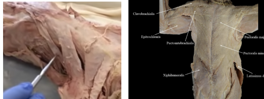 <p>Assists pectoralis minor to adduct arm.</p>
