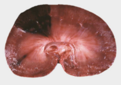 <p>What pathology is associated with the local</p><p>wedge-shaped area of necrosis in this kidney?</p><p>A. Infarction</p><p>B. Ischemic necrosis</p><p>C. Emboli</p><p>D. Coagulative necrosis</p><p>E. All of above</p>