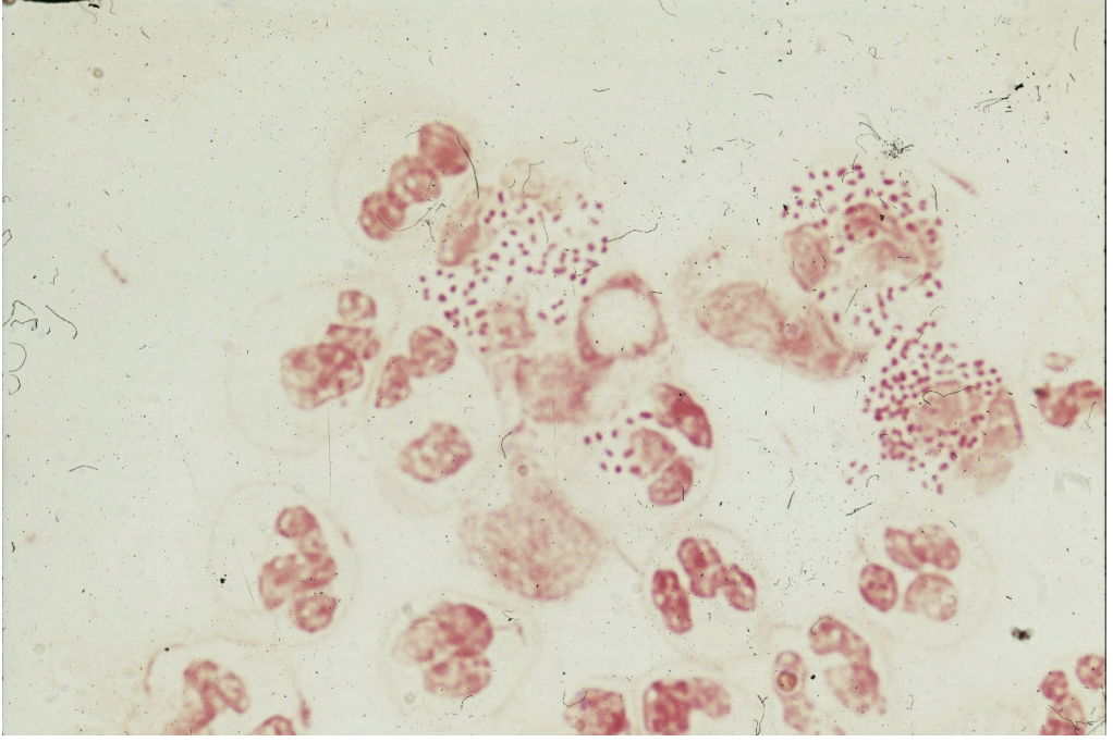 <p>URETHRAL SMEAR FROM A PATIENT WITH GONORRHOEA </p>