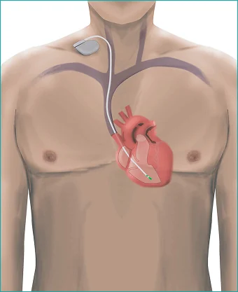 <p>What is a temporary cardiac pacemaker, and why is its disconnection dangerous?</p>