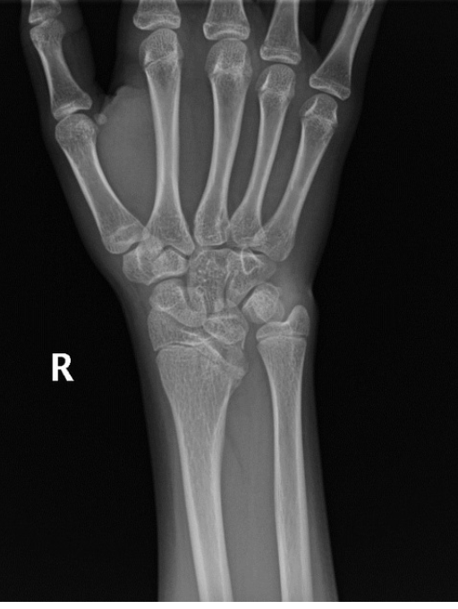 <p>Shortened distal radius, asymmetrical prominence of ulnar styloid, posterior subluxation of distal ulna </p>
