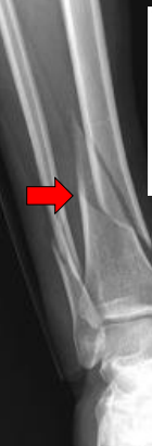 <p>What fracture is this?</p>