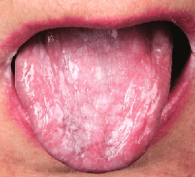 <p>type of papules that has <span style="color: red;">presence of carcinoma</span></p>