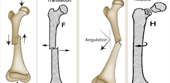 <p>name each type of fracture displacement</p>
