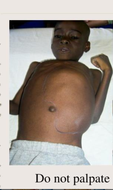 <ol><li><p><span style="color: rgb(240, 83, 83);"><strong>DONT palpate</strong></span> abdomen!! (can rupture it(</p></li><li><p>prep for <span style="color: rgb(38, 161, 84);"><strong>nephrectomy</strong></span></p></li><li><p><span style="color: rgb(195, 50, 235);"><strong>NO contact</strong> sports</span>!!!!</p></li></ol><p></p>