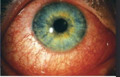 <p>-same as viral conjunctivitis but with corneal involvement</p><p>-injection, moderate pain, tearing</p><p>-edema of the lids</p><p>-possible chemosis</p><p>-pseudomembranous</p>