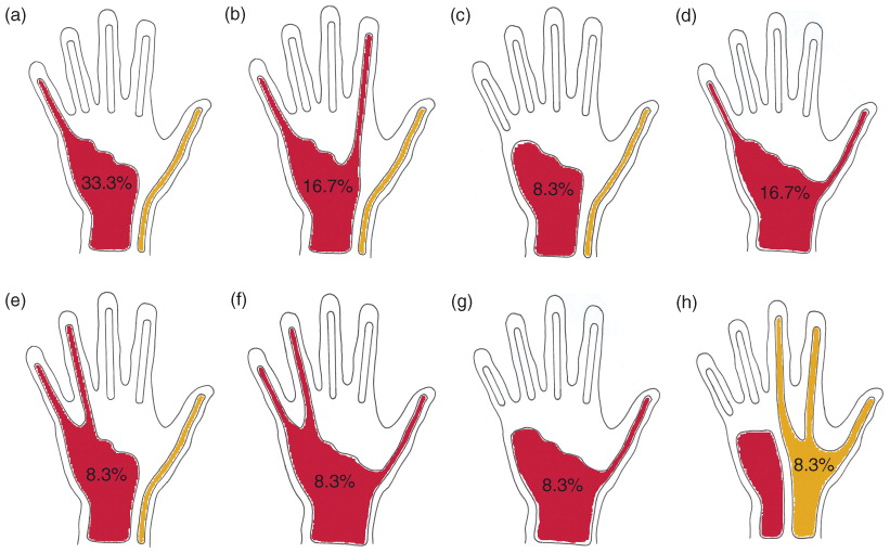 <ul><li><p>in hand, tendons of flexor digitorum superficialis &amp; profundus invaginate a <strong>common synovial sheath</strong></p><ul><li><p>sometimes called ulnar bursa</p></li></ul></li><li><p>medial part extends distally w/o interupption on tendons of little ginger</p></li><li><p>lateral part of seath ends on middle of palm</p></li><li><p>distal ends of long flexor tendons of index, middle, &amp; ring fingers acquire digital synovial sheaths as they enter the fingers</p></li></ul><p></p><p>*pattern of infection spread</p><p></p>