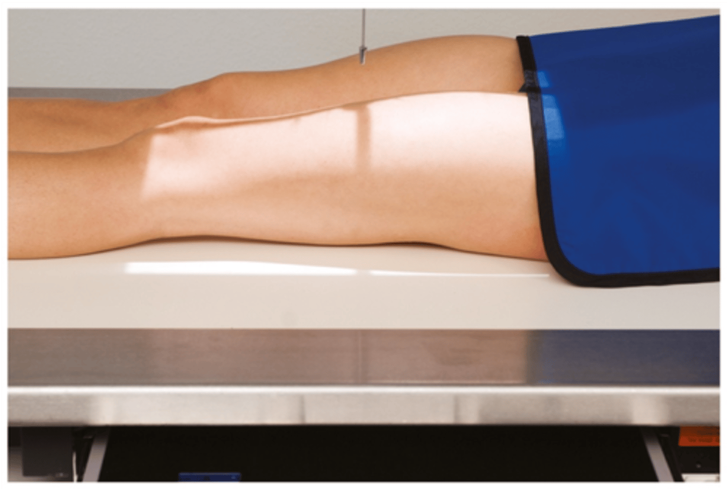 <p>S - outside light</p><p>T - 25 mAs @ 75 kVp</p><p>A - none</p><p>M - on table</p><p>P - PT supine w/ toes pointed to ceiling, bottom of cassette 2" below knee joint</p><p>S - 40"</p><p>B - suspension</p><p>C - 14 x 17 lenthwise, collimate side to side</p>