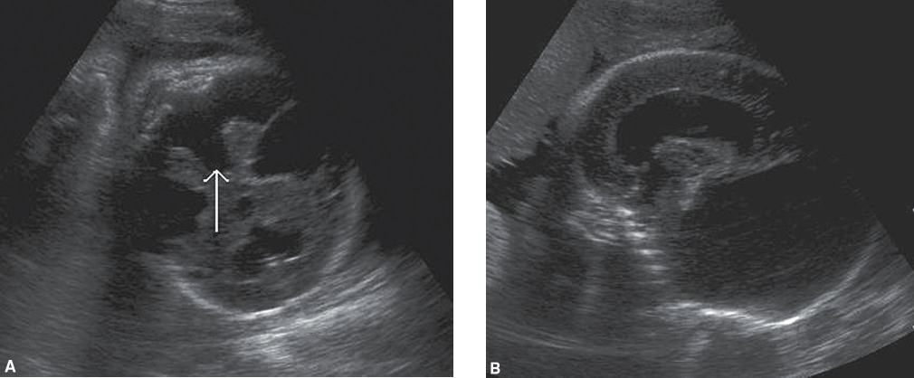 <p>Enlargement of the cisterna magna greater than 10 mm</p><p>Communication of the enlarged cisterna magna with a dilated fourth ventricle</p><p>Agenesis or hypoplasia of the cerebellar vermis</p><p>splayed lobes</p><p>Varying degrees of ventriculomegaly</p>