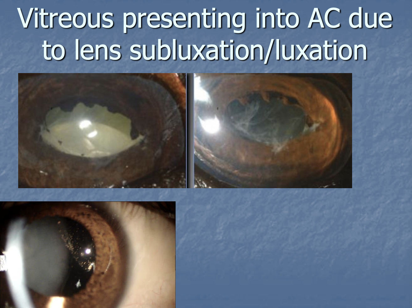 <p>lens luxation.</p>