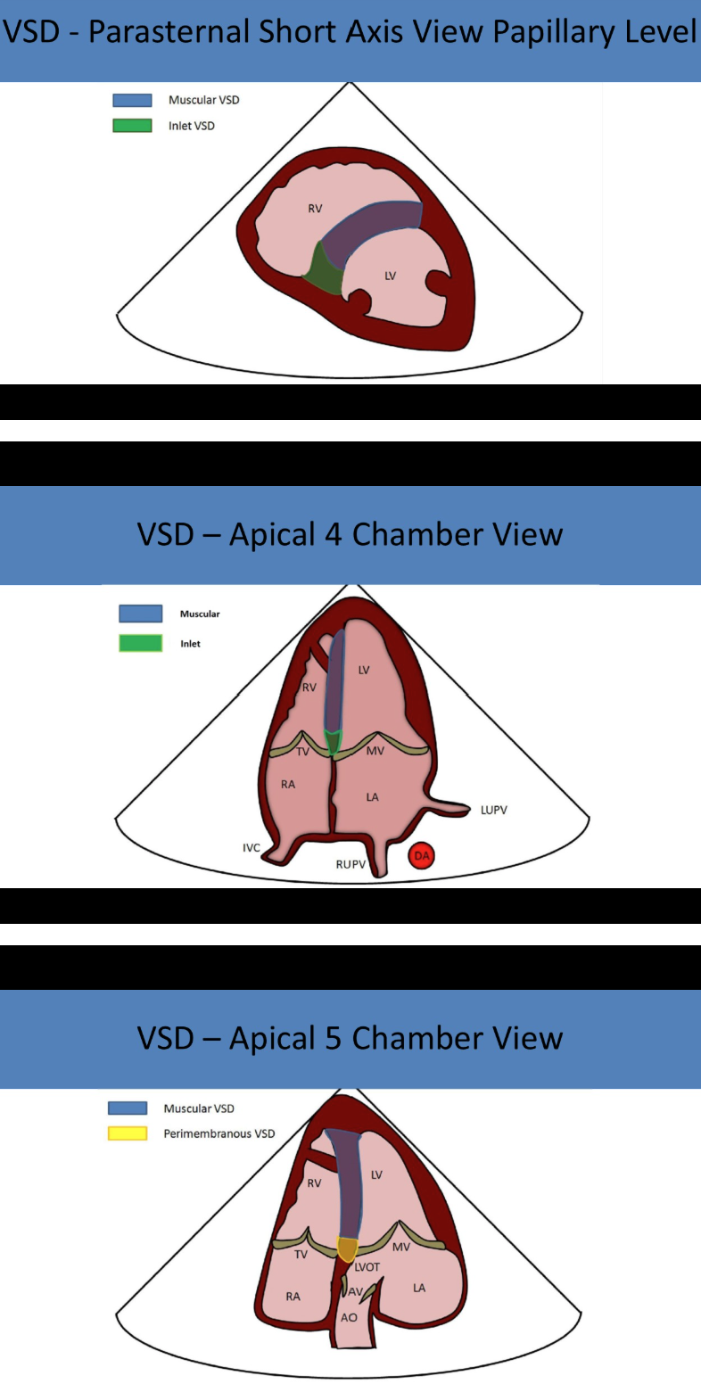<p>subcostal views </p>