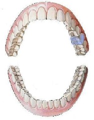<p>maxillary left first molar</p>
