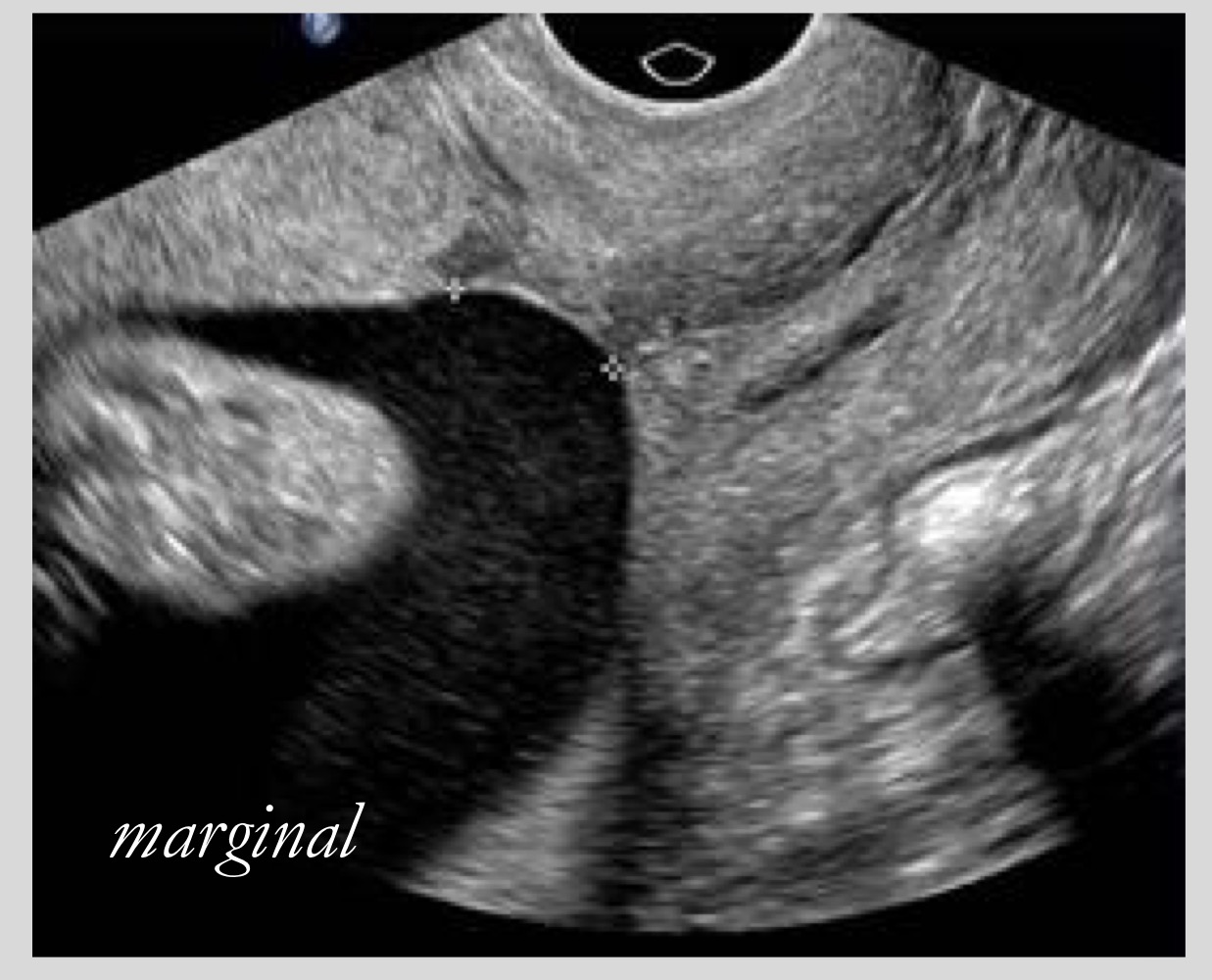 <p>Placenta is within 2 cm of the internal os but not covering it</p>