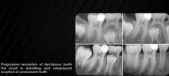 <p>resorption</p>