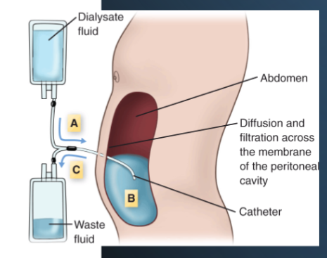<p>how often is it received: every day for 8-10 hours</p><p>where is it performed: home- usually when sleeping </p><p>why does a patient receive this and not HD: if they couldn’t get a fistula or graft (access problems), when waiting for AV fistula to mature</p><p>different types of access: abdomen (surgically placed)</p><p>contraindications: recent abdominal surgery, excessive scaring in peritoneal region</p><p>complications, nursing interventions: peritonitis- infections of peritoneum or blood vessels in stomach- fluid will look cloudy (prevent by maintaining sterility when touching catheter)</p><p>nursing assessment: watch fluid may look cloudy if its peritonitis, pain level</p>