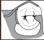 <p>Type of Direct retainer shown</p>