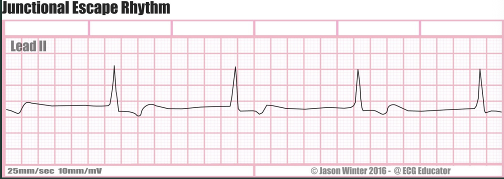 <p>What’s characteristic of a junctional escape rythm?</p>