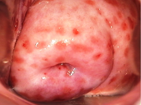 <p><span>Inflammation of the cervix characterised by a purulent endocervical exudate and/or easily induced endocervical bleeding (caused by manipulation with an atraumatic instrument like a cotton swab)</span></p><p><span><strong>Pathogens</strong>: </span><em>Neisseria gonorrhoeae</em><span>, </span><em>Chlamydia trachomatis, HSV</em></p><p><span><strong>Sx</strong>: Often Asymptomatic, ‘Strawberry Cervix’ (<em>trach.</em>), postcoital bleed, purulent vaginal/cervical discharge </span></p><p><span><strong>Cx</strong>: Pelvic Inflammatory Disease (</span>if left undiagnosed or untreated<span>) → infertility, chronic pelvic pain</span></p>