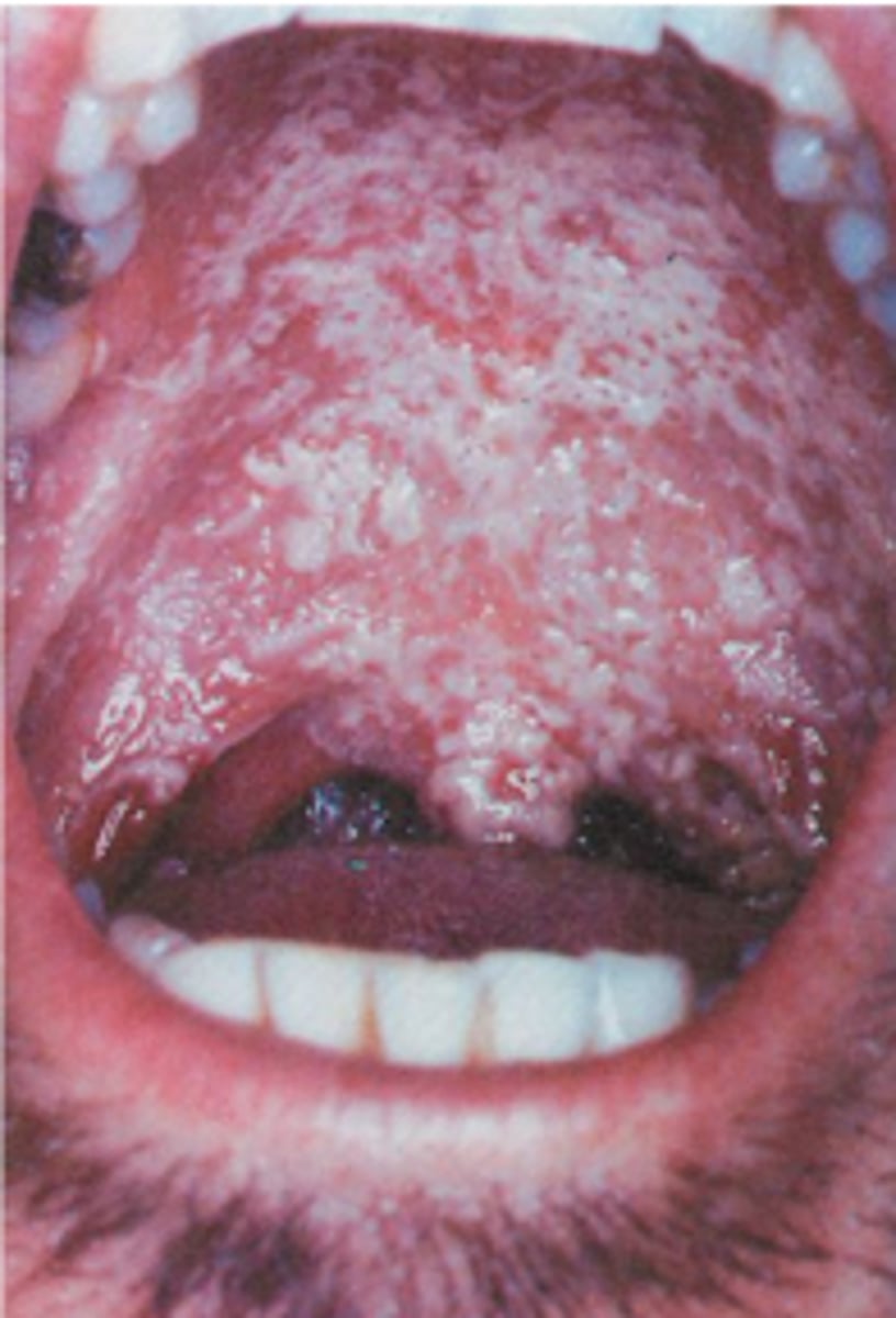 <p>Thrush is a yeast infection from Candida species.&nbsp;</p><p>appear as cream-colored or bluish-white pseudomembranous patches on the tongue, mouth, or pharynx.</p><p>Thick, white plaques are somewhat adherent to the underlying mucosa.&nbsp;</p><p>Predisposing factors include prolonged treatment with antibiotics or corticosteroids and immunocompromised status.</p>