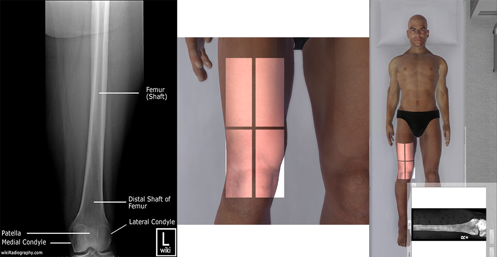 <p>collimate to include distal 2/3 of femur and knee joing should NOT be open </p>