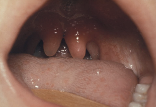 <p>minimal manifestation of CP</p>