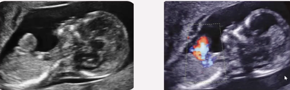 <ul><li><p>exposed heart<span style="color: red;"> outside chest wall through cleft sternum</span></p></li><li><p>most dramatic finding is presence of heart outside thoracic cavity</p></li><li><p>anomalies most frequently associated with ectopia cordis:</p><ul><li><p><span style="color: red;">omphalocele</span></p></li><li><p>cardiovascular malformations</p></li><li><p>craniofacial defects</p></li></ul></li></ul><p></p>