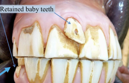 <p><span style="background-color: transparent; font-family: "Times New Roman", serif;">Retained deciduous teeth</span></p><ul><li><p><span style="background-color: transparent; font-family: "Times New Roman", serif;">Permanent teeth erupt without loss of baby teeth</span></p></li><li><p><span style="background-color: transparent; font-family: "Times New Roman", serif;">Requires surgical removal if they don't resolve on their own</span></p></li><li><p><span style="background-color: transparent; font-family: "Times New Roman", serif;">Can result in malalignment of permanent teeth</span></p></li></ul><p></p>