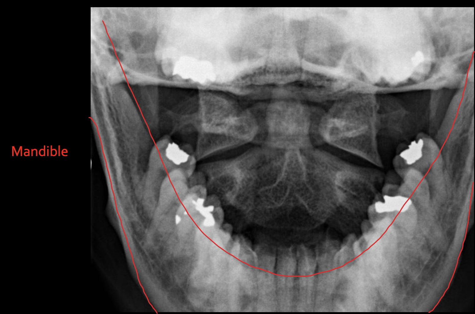 <p><strong>Mandible</strong></p>
