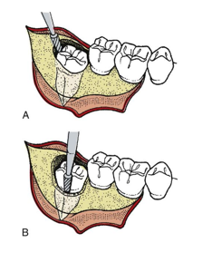 <p>-bone removal</p>