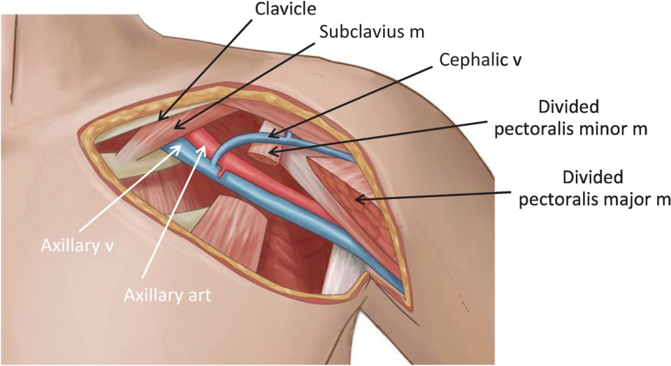 <p>axillary</p><ul><li><p>in armpit</p></li></ul><p>cephalic</p><ul><li><p>in head, top of shoulder</p></li><li><p>typically drains in axillary vein </p></li></ul><p></p>
