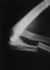 <p>Tipo de fractura en esta rx</p>