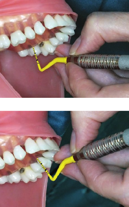 <ul><li><p>1—2 o’ clock position</p></li><li><p>Chin up</p></li></ul><p></p><p><strong>Mirror use (Retraction)</strong></p><ul><li><p>Use mirror for indirect vision</p></li></ul><p></p><ol><li><p><strong>Second molar, lingual aspect</strong></p></li></ol><ul><li><p>Finger rest on the occlusal surface</p></li></ul><p></p><ol start="2"><li><p><strong>First premolar, lingual aspect</strong></p></li></ol><ul><li><p>Finger rest on occlusal surface or incisal edge </p></li></ul><p></p>
