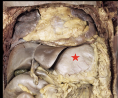 <p>Which of the following statement is correct regarding the marked structure:</p><p>A) Received its blood supply from the superior mesenteric artery</p><p>B) It is foregut structure</p><p>C) Receives blood supply from both celiac trunk and SMA</p><p>D) It is retroperitoneal</p>