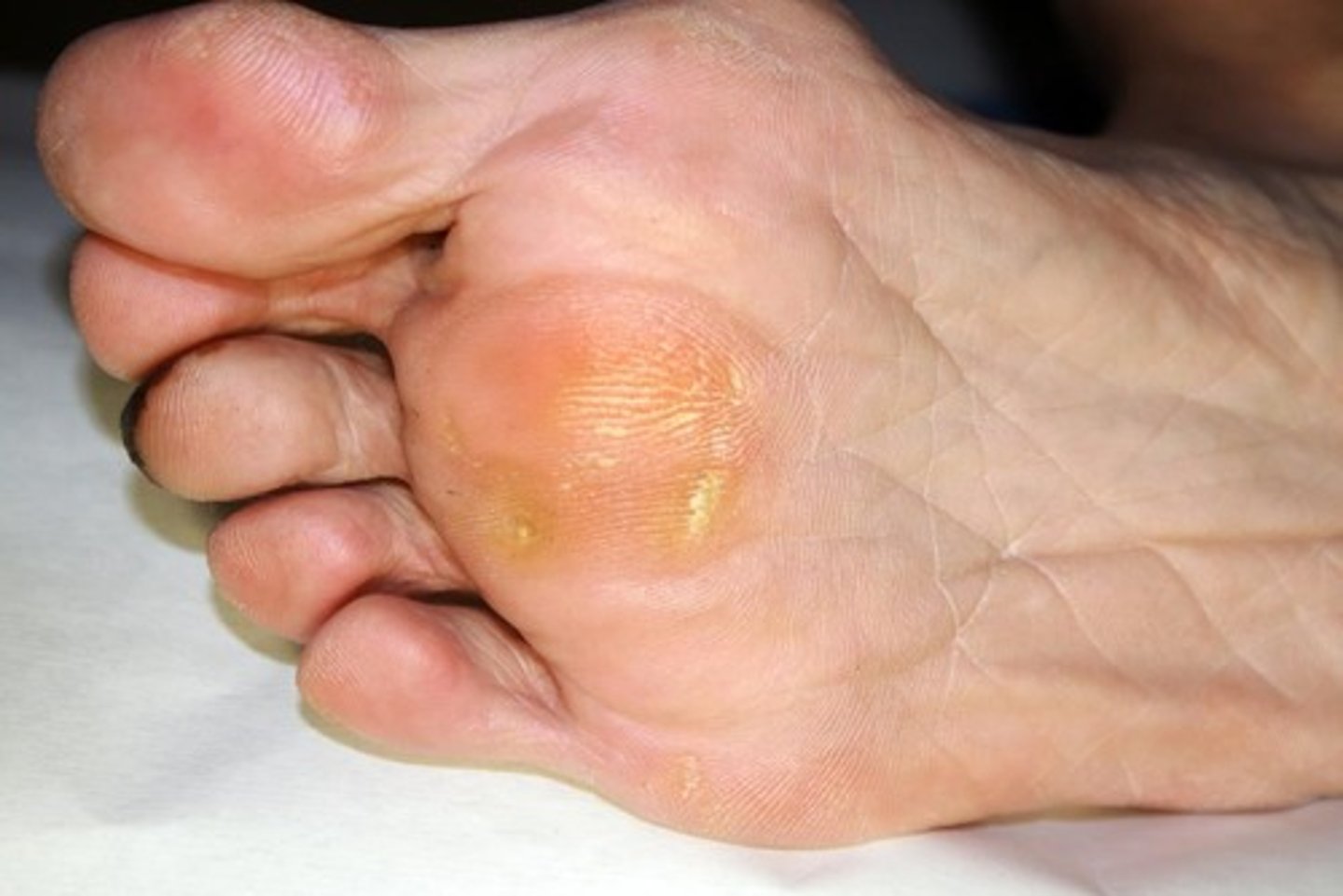 <p>Acquired, superficial, thickened patch of the epidermis. </p>