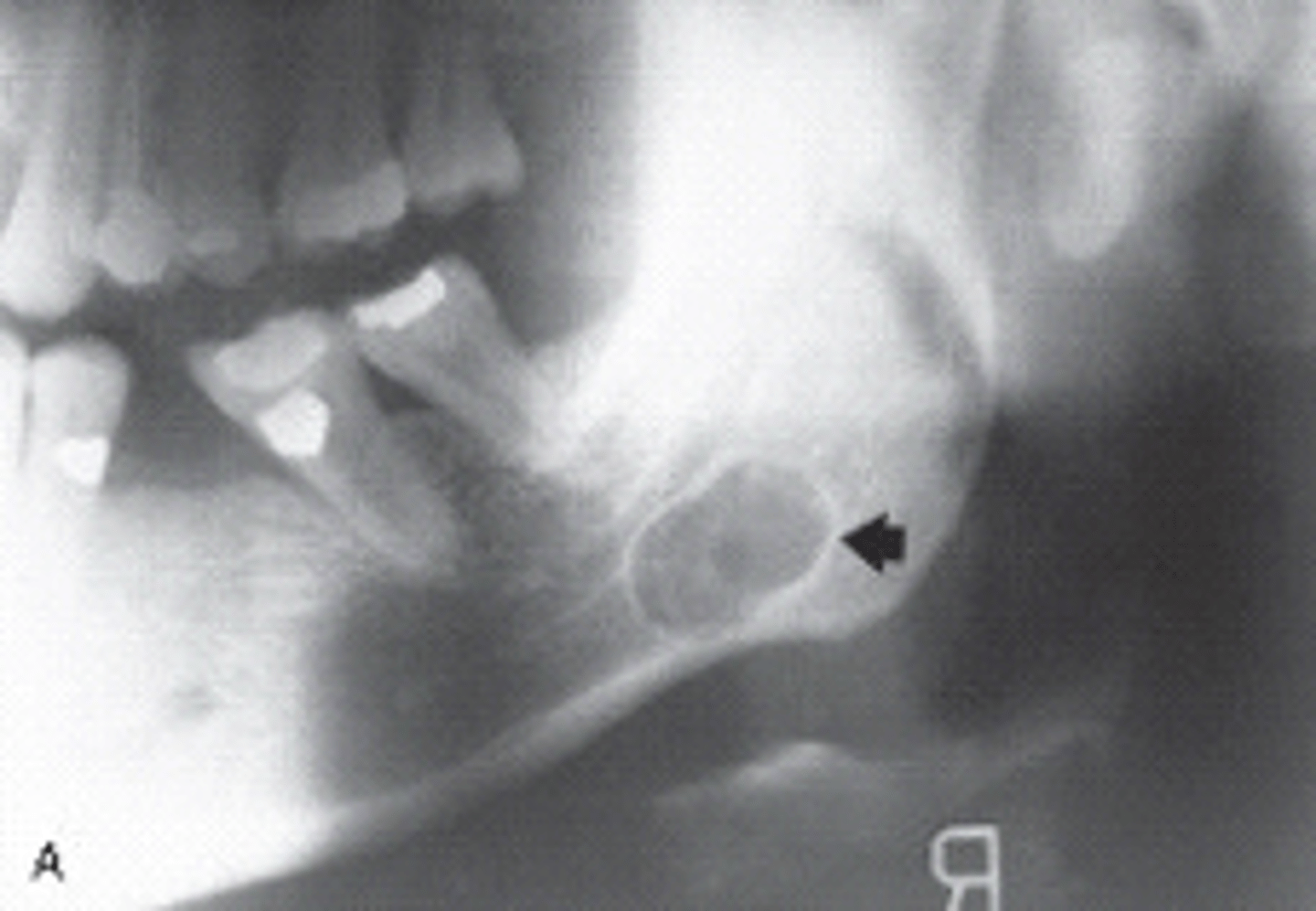 <p><br>Radiolucency in posterior mandible below mandibular canal due to lingual concavity of jaw</p><p><br><span>This pseudocyst seen is surrounded by salivary gland tissue.</span></p>