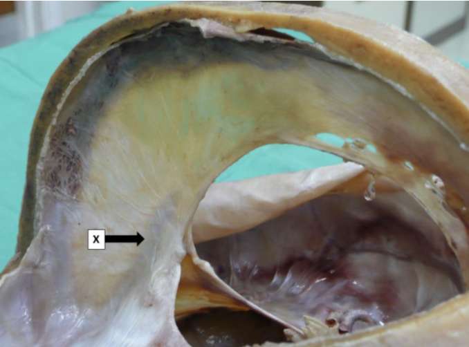 <p>Which statement(s) concerning structure X is/are true?</p><p>i. This is the transverse sinus.</p><p>ii. This is the straight sinus.</p><p>iii. It lies mostly within the falx cerebri.</p><p>iv. It lies mostly within the falx cerebelli.</p>