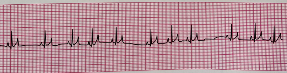 <p><span>The ______ arrhythmia is common under anesthesia for dogs. It is characterized by longer than normal spaces between QRS complexes and corresponds with breathing. Please name the arrhythmia shown below.</span></p>