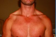 <p>step deformity</p>